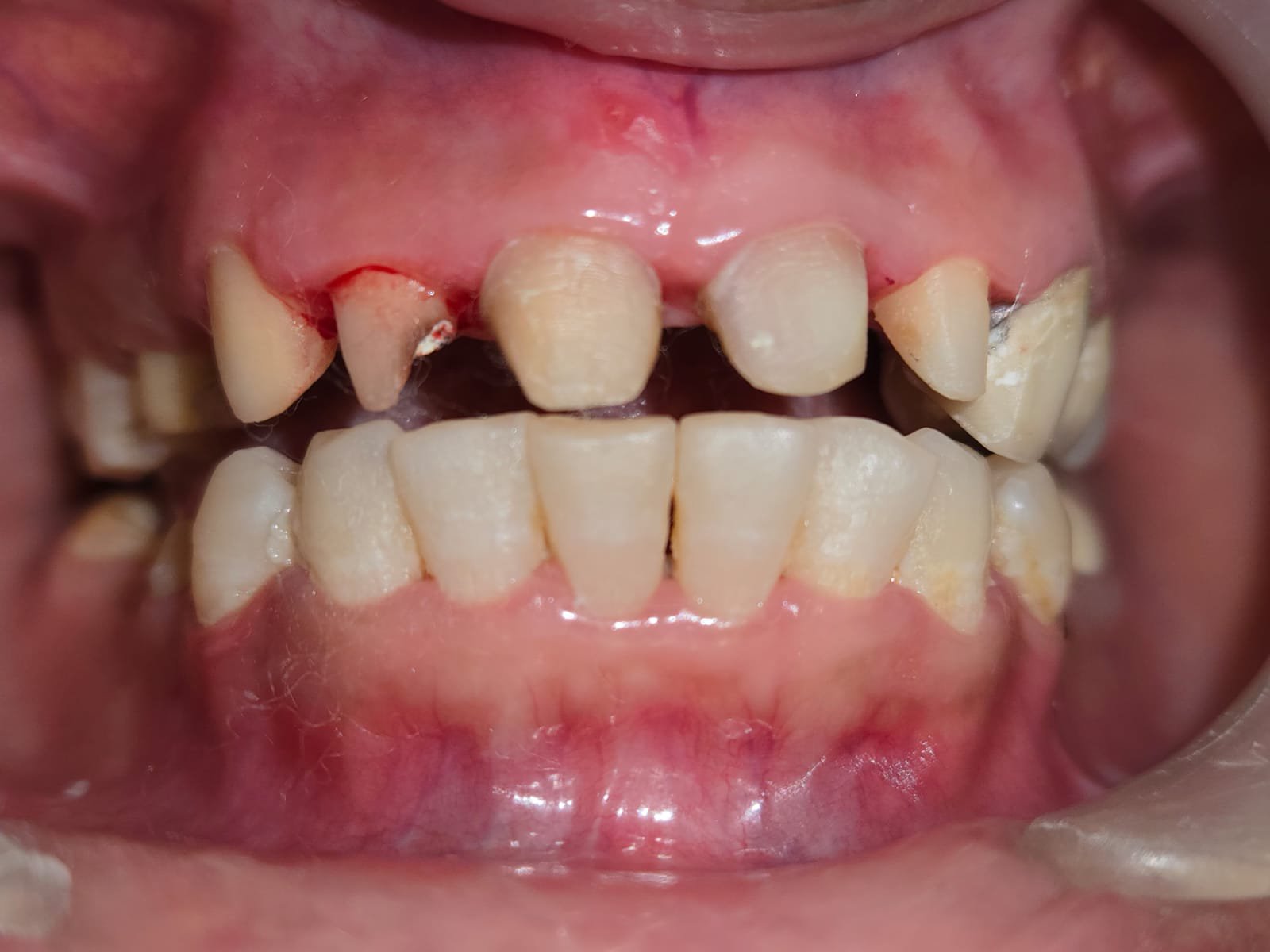 Worn Dentition