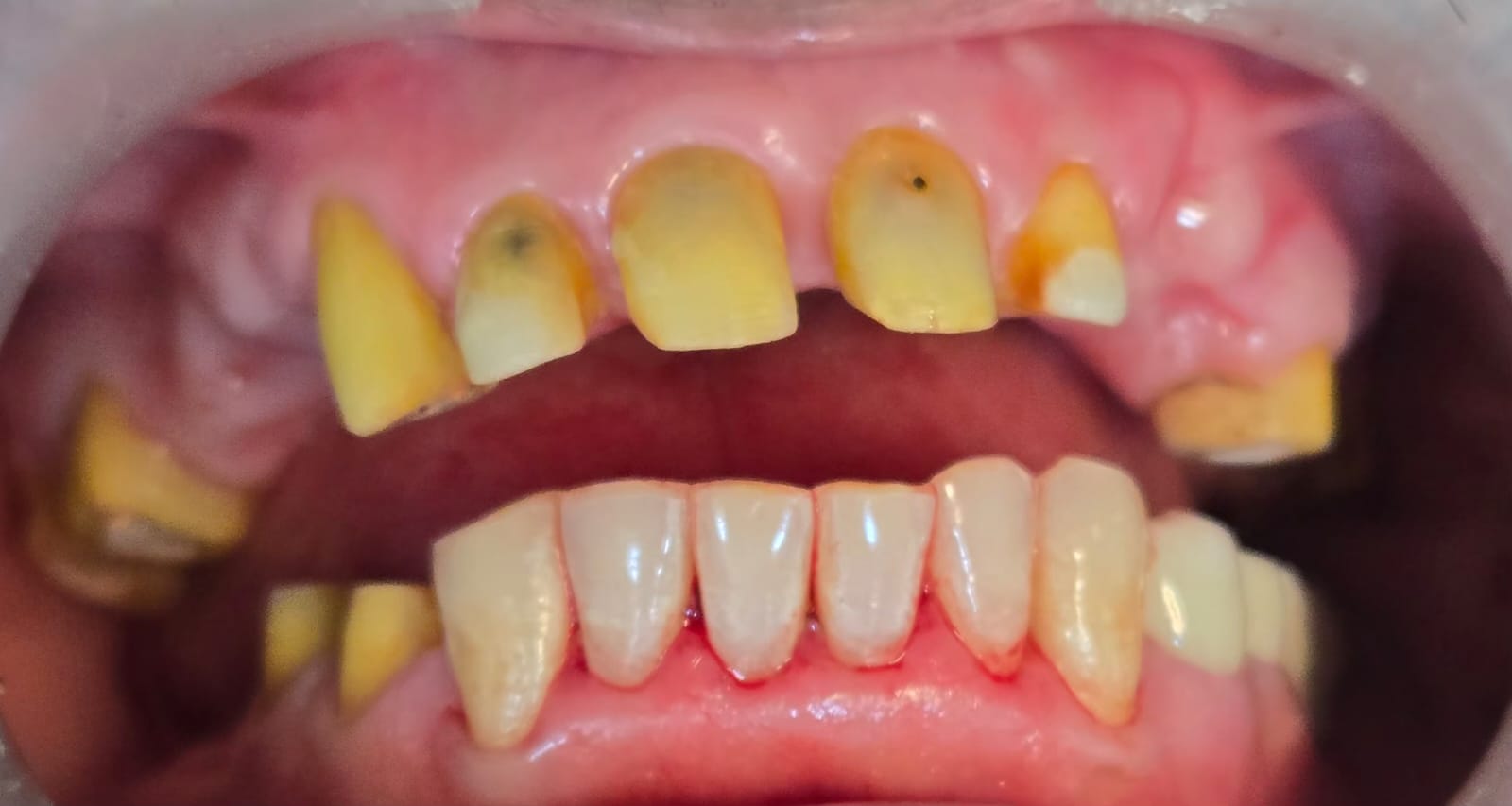 Damaged Teeth