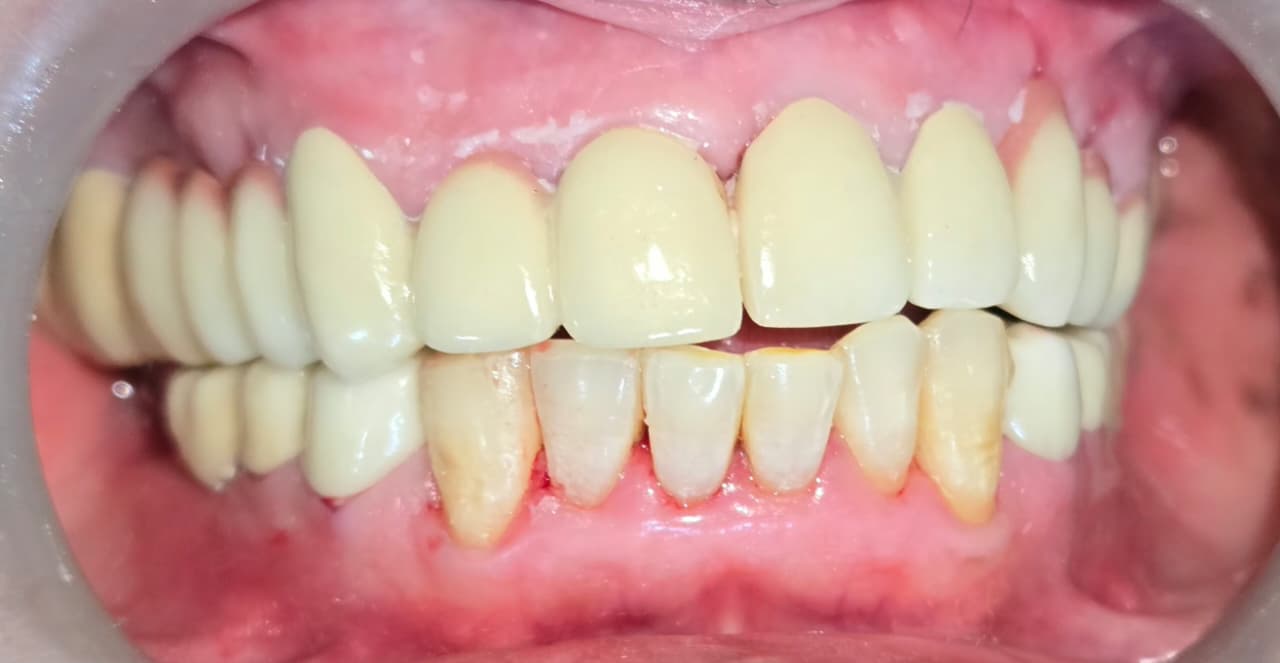 Restored Smile