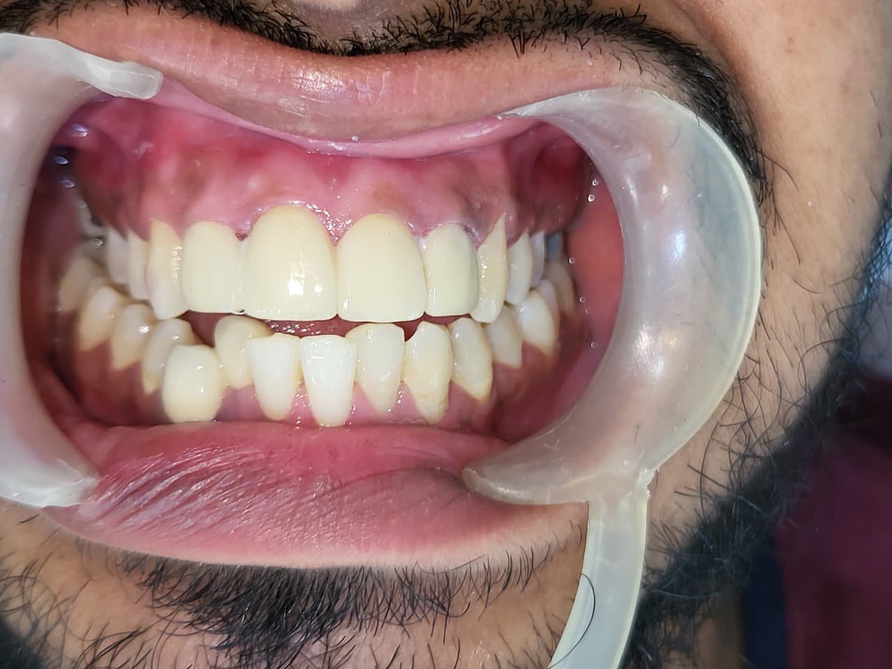 Painless Restoration