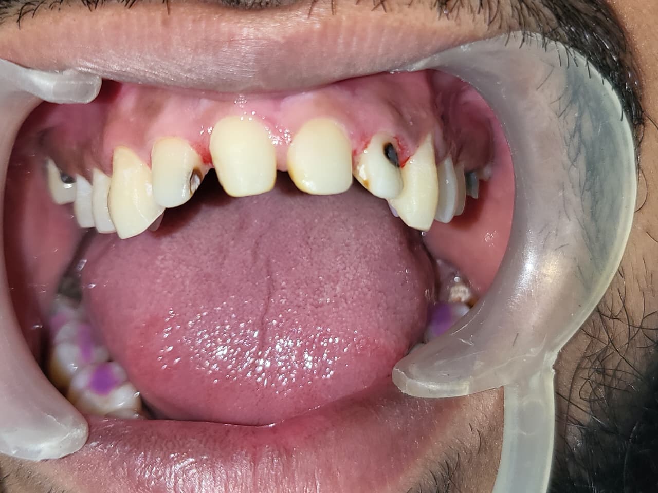 Decayed Tooth