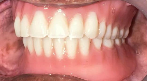 After Treatment