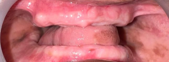 Before Treatment