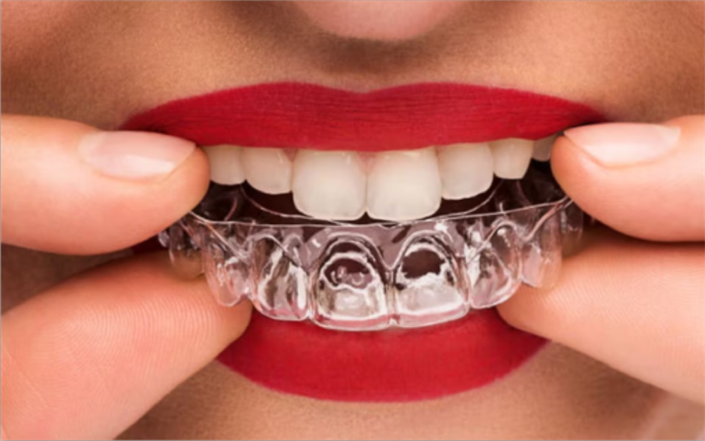 Clear Aligners
