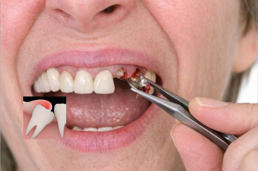 Fracture Tooth Management