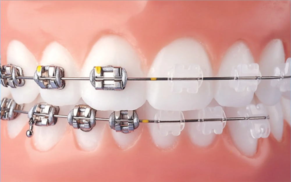 Dental Braces