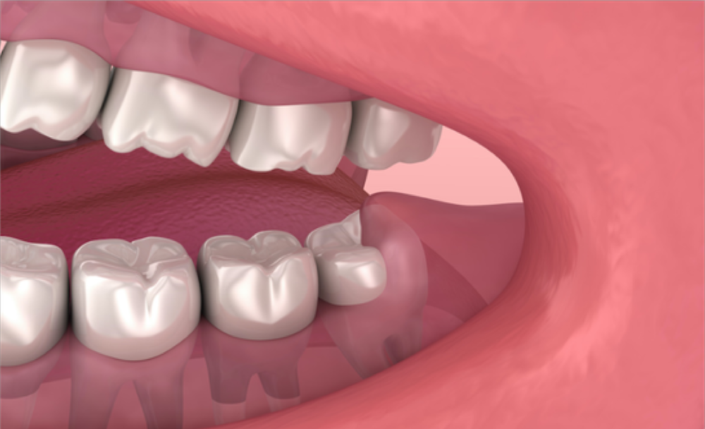 Wisdom Tooth Treatment