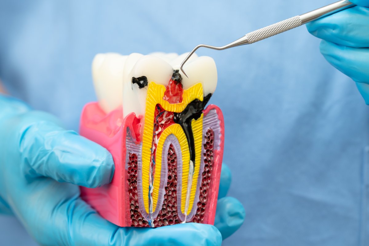 Root Canal