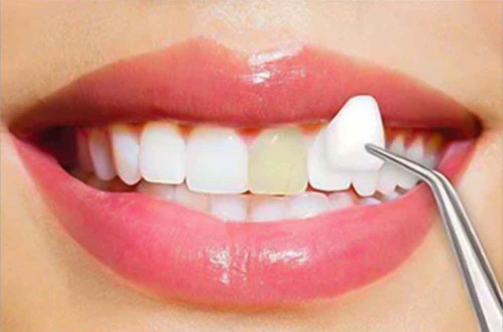 Veneers